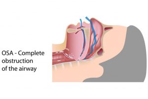 โรคหยุดหายใจขณะหลับจากการอุดกั้น (OBSTRUCTIVE SLEEP APNEA: OSA)